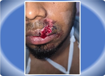 FACIAL INJURY